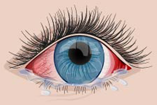Vörös szem - mikor kell szemészhez fordulni?