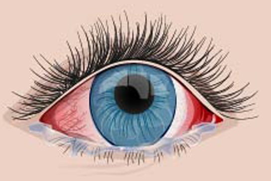 vörös szem rossz látás Thai teák a látás javítására