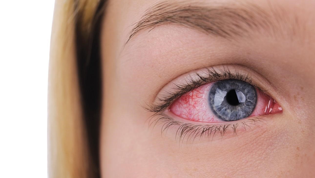 Red Eyes: Causes and Treatment for Bloodshot Eyes