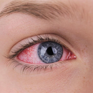 Woman With An Extremely Bloodshot Eye.